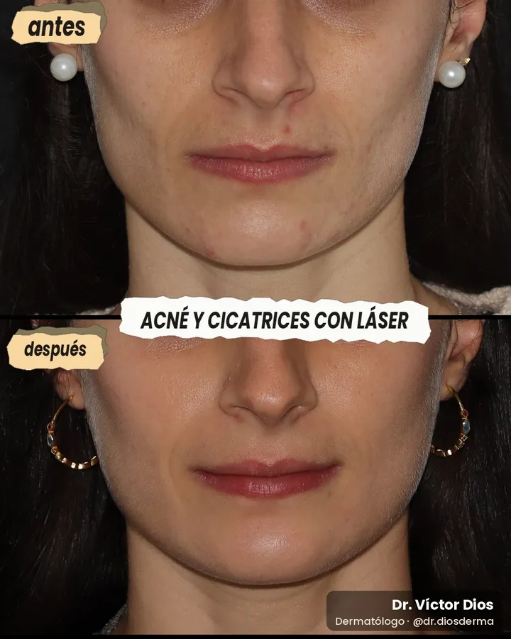 Antes y después de acné y cicatrices con láser, vista frontal