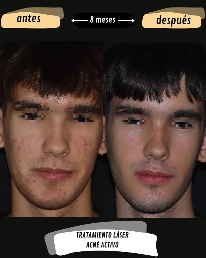 Antes y después de tratamiento láser de acné activo, vista frontal