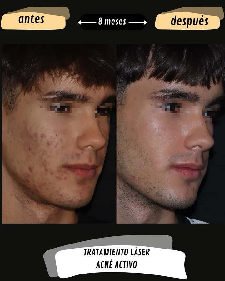 Antes y después de acné activo tratado con láser, vista lateral derecha