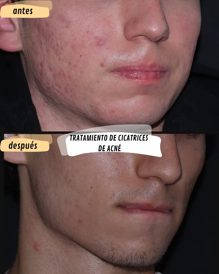 Antes y después de cicatrices de acné, lado derecho