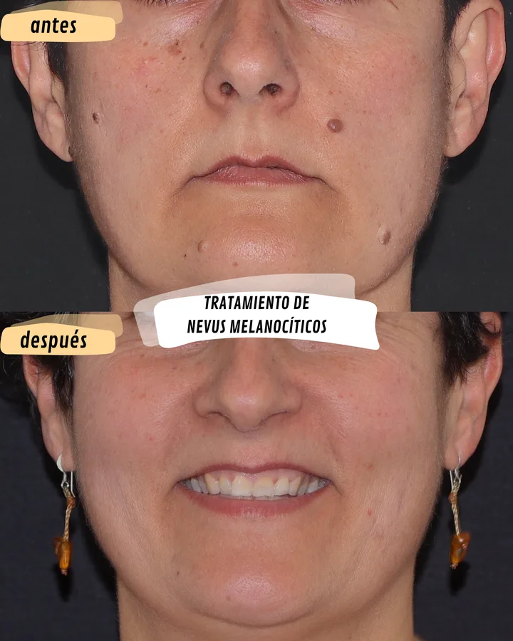 Antes y después de eliminación de nevus melanocíticos faciales