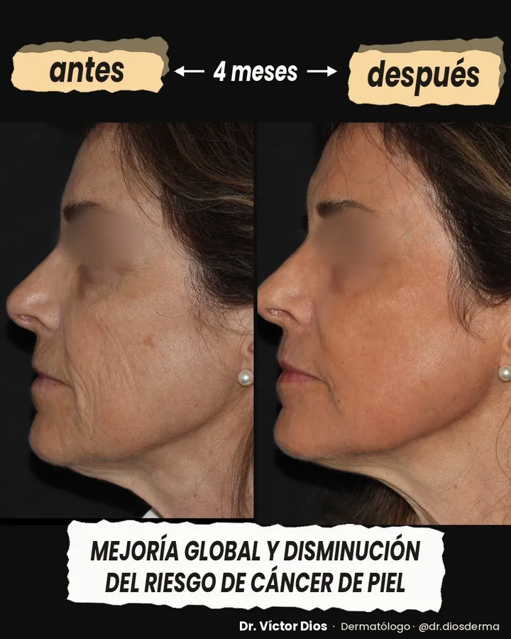Antes y después de láser CO2, vista de perfil